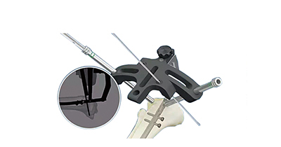 PEEK股骨.胫骨Gamma髓内钉瞄准器械